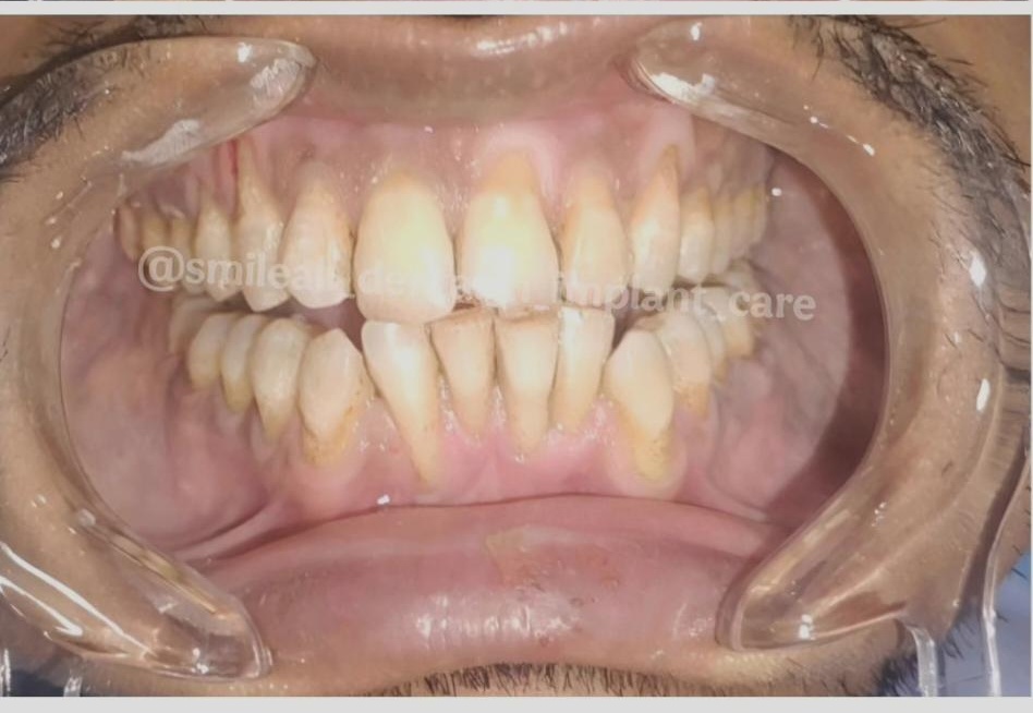 After dental cleaning