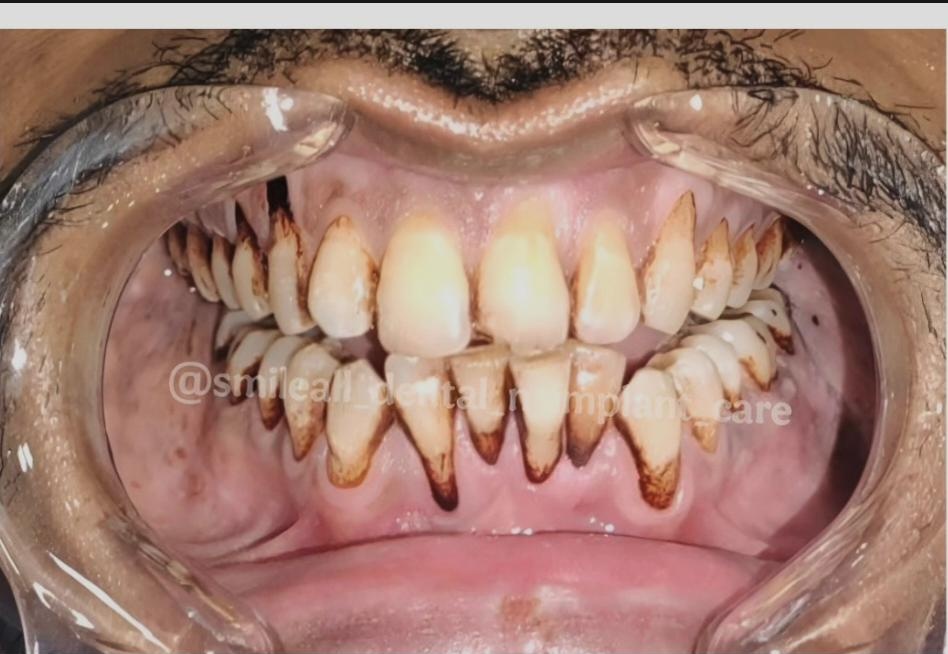 Before dental cleaning
