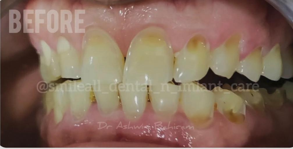 Before teeth whitening
